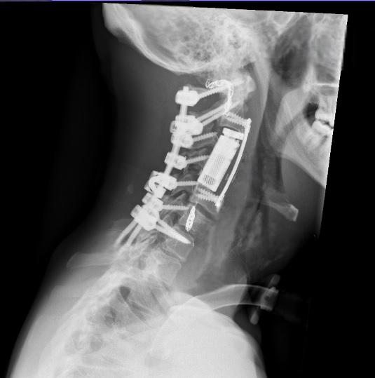 KHCC Performs First-of-Its-Kind Surgery to Remove Complex Cervical Tumor