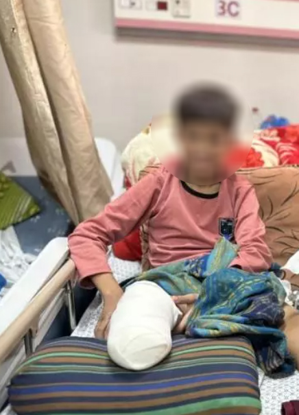 منظمة أميركية: 6 آلاف مبتور في غزة يحتاجون إعادة تأهيل عاجل ودعم نفسي