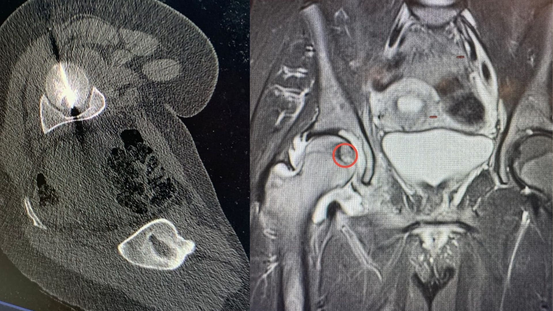 UJ Hospital Achieves Breakthrough in Bone Tumor Treatment