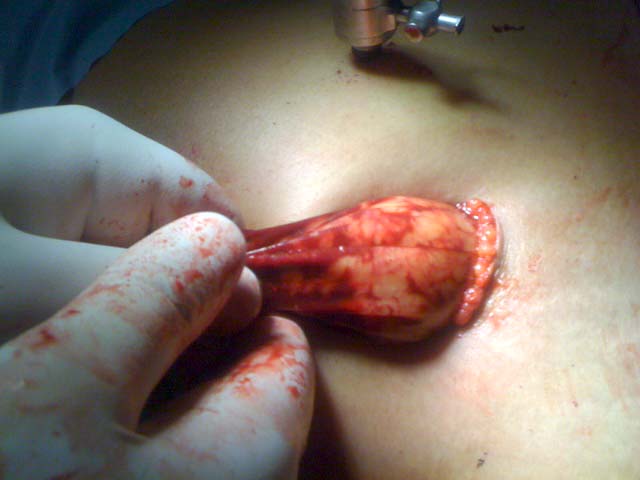 استئصال كلية بالمنظار في مستشفى الامير حمزة هي الاولى بوزارة الصحة