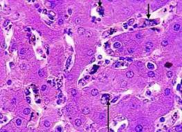 الامم المتحدة :الملاريا يتسبب بوفاة طفل كل دقيقة