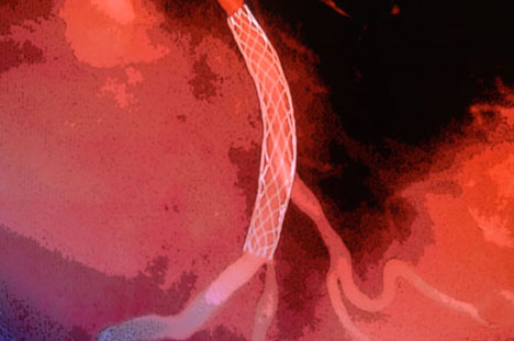 تسجيل أول شبكة شرايين قلبية قابلة للذوبان